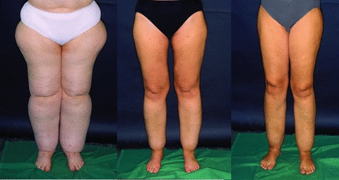 Heavy hips and legs: Could you have lipedema? – Diet Doctor