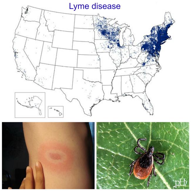 tick bite lyme disease